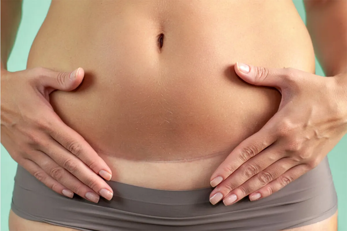 Does Weight Gain After Hysterectomy Causes and Prevention