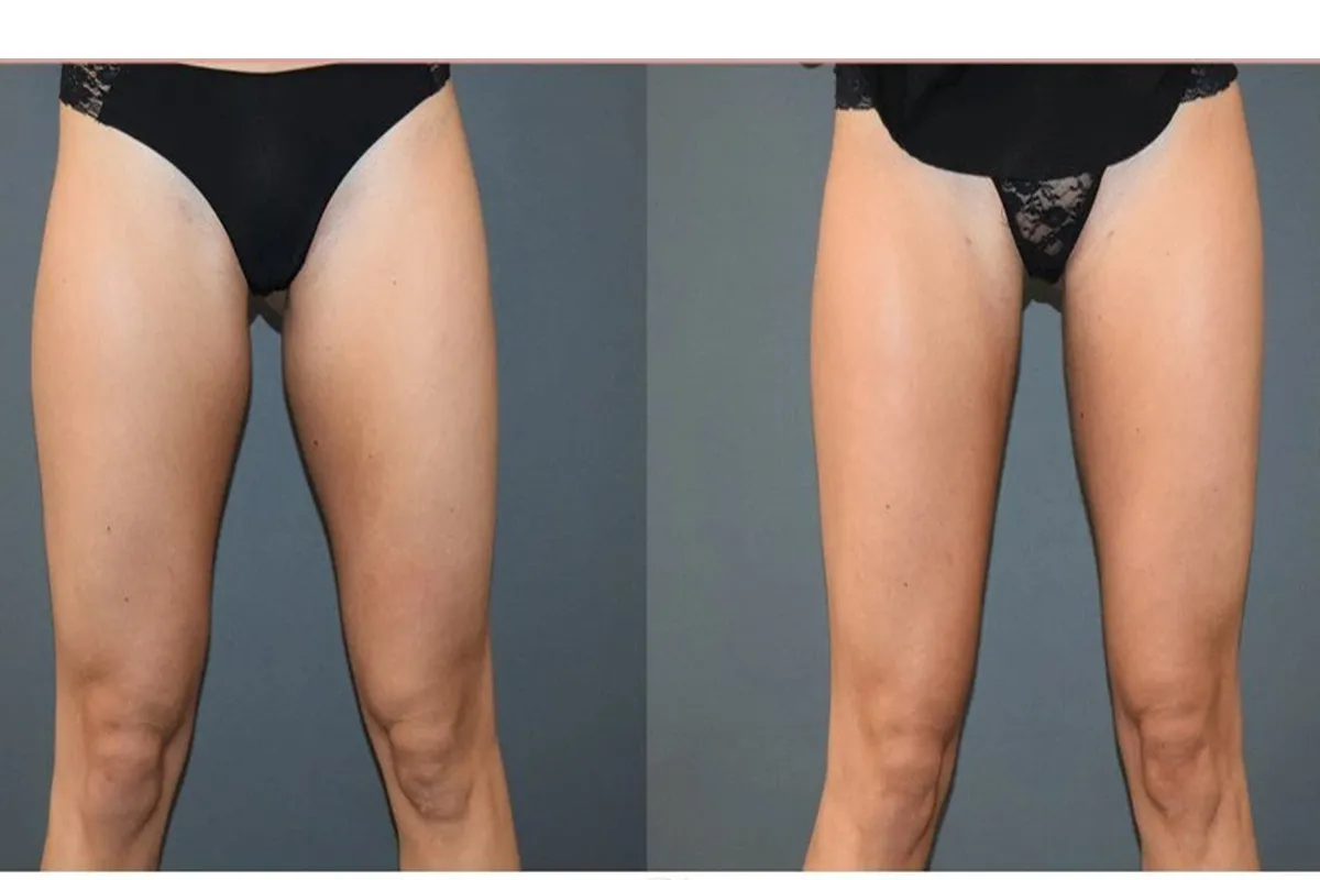 Recovering After Thigh Liposuction